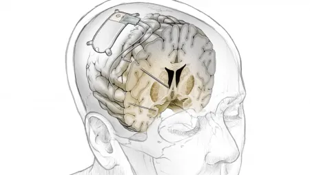 Implant w mózgu usunie depresję