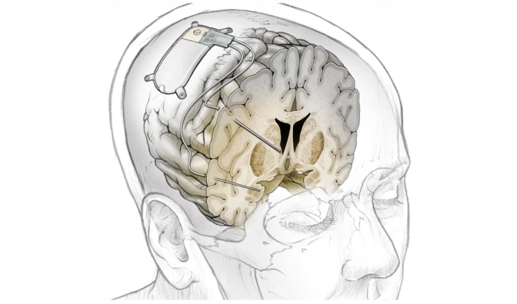 Implant w mózgu usunie depresję